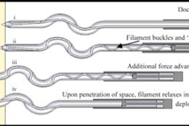 Diagram showing how a new needle developed at MIT works (from top to bottom):
i. Doctor pushes here. 
ii. Filament buckles and 'locks' inside tube. 
iii. Additional force advances entire device.
iv. Upon penetration of space, filament relaxes inside tube and deploys into space.