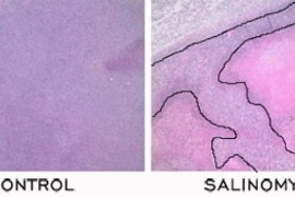 In a comparison of a control to the chemical identified by the Weinberg/Lander team, called salinomycin, the tumor cells (stained dark purple in both slides) were unaffected by the control, butÂ salinomycin killedÂ many tumor cells (stained pink).