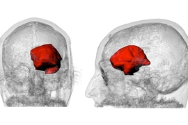 A 3-D visualization of Keating’s MRI data with the large astrocytoma tumor highlighted in red.