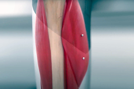 A rendering shows a skeletal bone with red muscle. 2 beads are on the muscle.