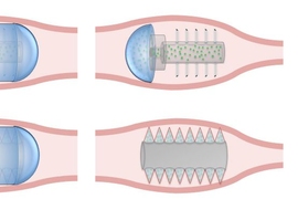 This therapeutic-use illustration of the microneedle pill shows the use of hollow needles and solid needles made from sugars or polymers. In both cases, the pill’s needles are initially coated by a pH-responsive coating to aid in ingestion (left). When the pill has reached the desired location in the GI tract, the coating dissolves, revealing the microneedles (middle). In the case of hollow mi...